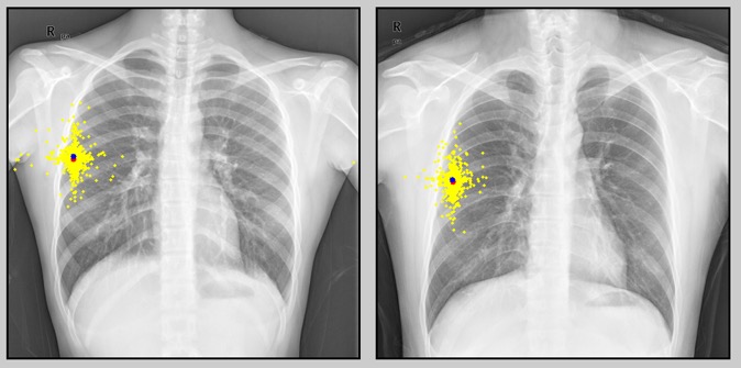 A Chest X-ray Rib Detection Method